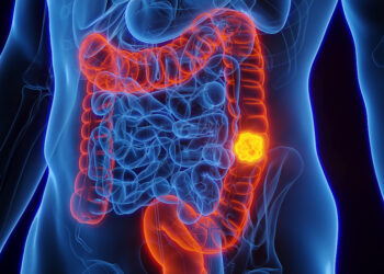 Colorectal cancer surgery