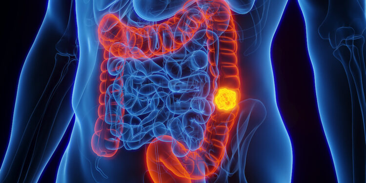 Colorectal cancer surgery