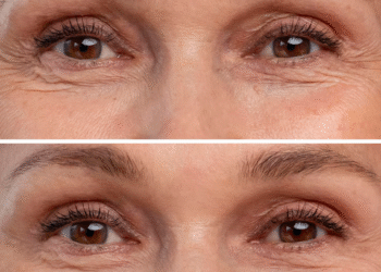 What Are the Signs You Might Need a Jowl Lift?