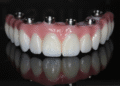 Transform Your Smile with All-On-4 Dental Implants
