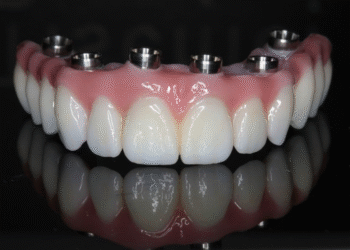 Transform Your Smile with All-On-4 Dental Implants
