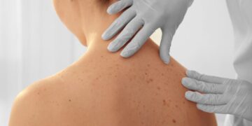 Skin Check Morningside for Early Detection