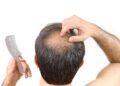 Expert Care for Alopecia Areata: Find the Best Specialist in London, UK