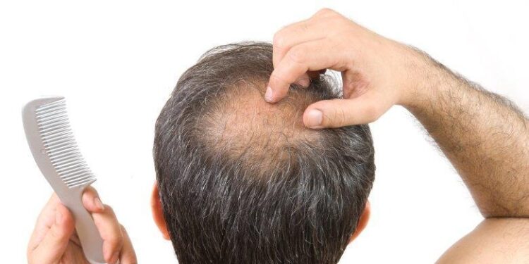 Expert Care for Alopecia Areata: Find the Best Specialist in London, UK