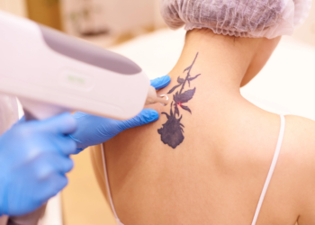 The Ultimate Guide to Tattoo Removal in 2026