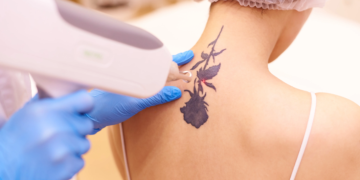 The Ultimate Guide to Tattoo Removal in 2026
