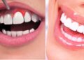 How Gum Health Shapes Cosmetic Dental Decisions