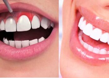 How Gum Health Shapes Cosmetic Dental Decisions
