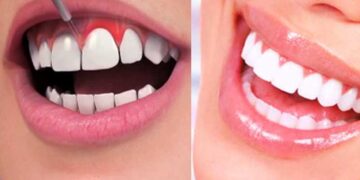 How Gum Health Shapes Cosmetic Dental Decisions